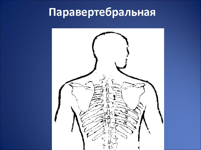 Паравертебральная